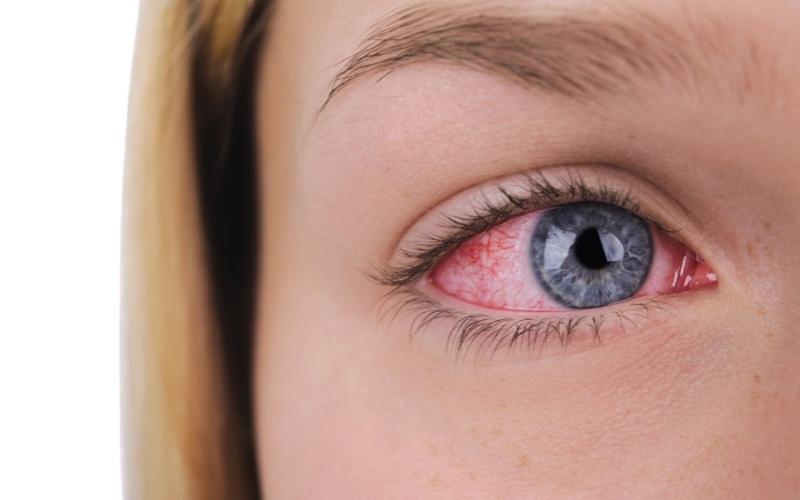 why does cannabis make your eyes red