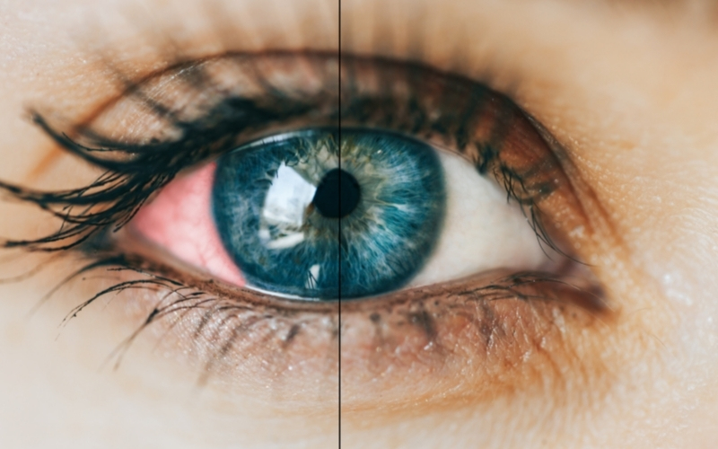 Why does cannabis make your eyes red?